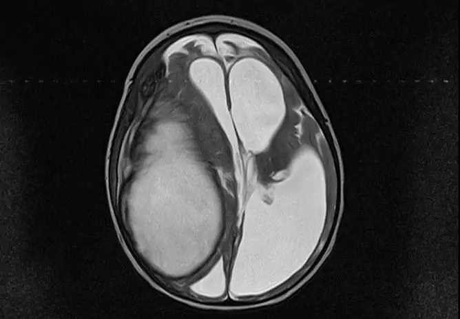 Hjerneabscess: Symptomer, Behandling, Konsekvenser, årsaker