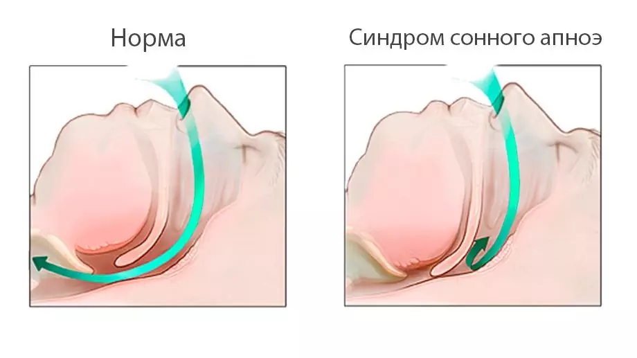 Apnea Notturna: Sintomi, Trattamento, Cause, Diagnosi