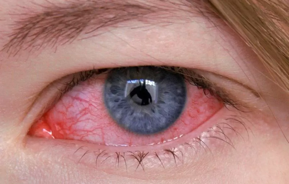 Adenovirale Konjunktivitis - Symptome, Behandlung Bei Kindern