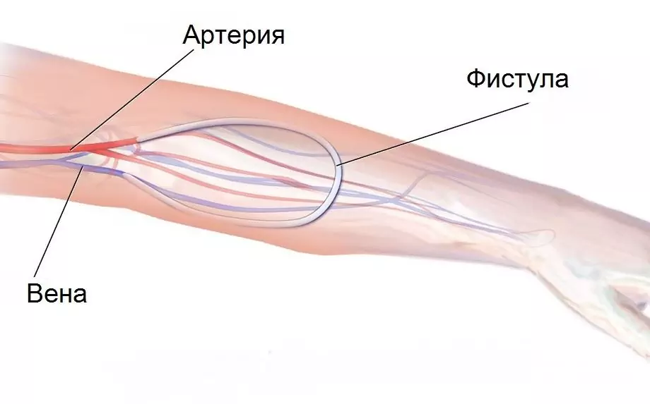 Merkkejä arteriovenoosisesta fistulasta