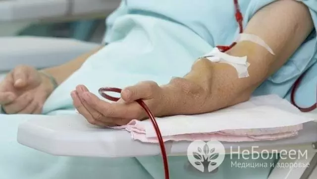 Fistula arteriovenoasă pentru hemodializă