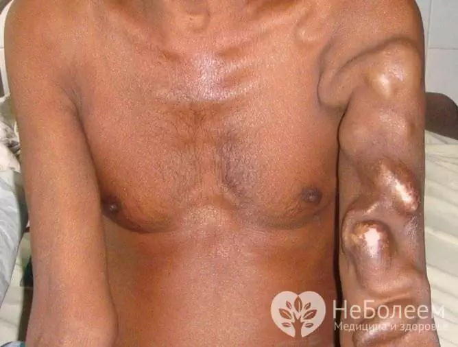 Bloated veins from arteriovenous fistula