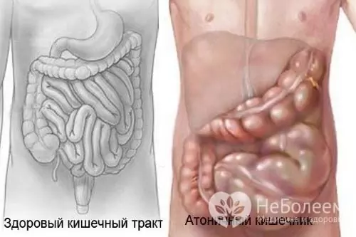 With intestinal atony, there is a low tone of its smooth muscles