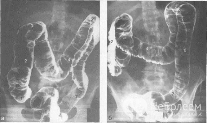 Irrigoskopi er den mest informative metoden for å diagnostisere tarmatoni