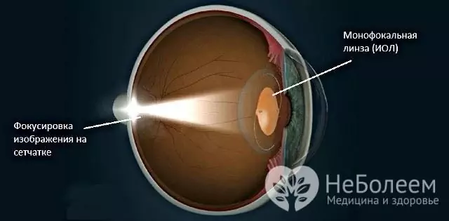 Intraokulär korrigering av aphakia består i att implantera en lins med erforderlig optisk kraft i ögongloben