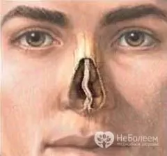 Kelengkungan septum hidung menyebabkan kesukaran bernafas