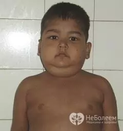 The main symptoms of Itsenko-Cushing syndrome are obesity of the trunk, neck and face