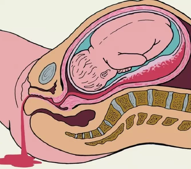 Pôrodnícke Krvácanie: Liečba, Prevencia, Príčiny