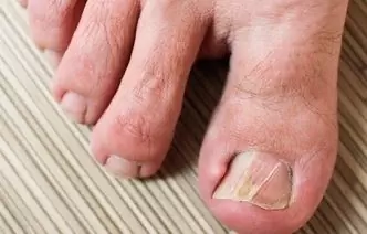 Ingrown Toenail: 10 Folk Remedies To Get Rid Of The Problem