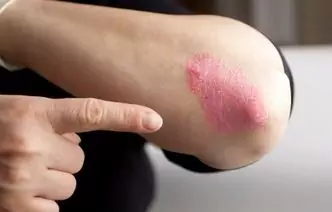 Como Evitar Crises De Eczema: 7 Regras