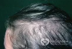 Androgén alopecia