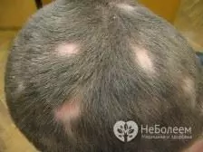 Alopecia areata