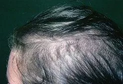 Androgenní Alopecie U žen - Léčba, Prognóza