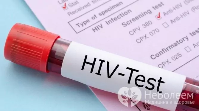 HIV infekcija