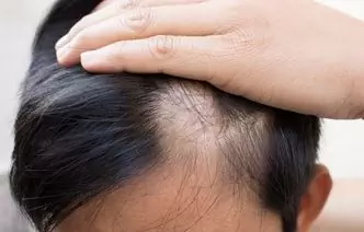 10 Myths About Male Alopecia