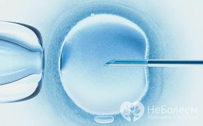 IVF procedure: possible complications