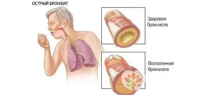 Vid akut bronkit utsöndras en liten mängd sputum