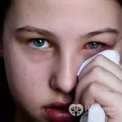 Konjungtivitis alergi biasanya disebabkan oleh reaksi alahan badan secara umum