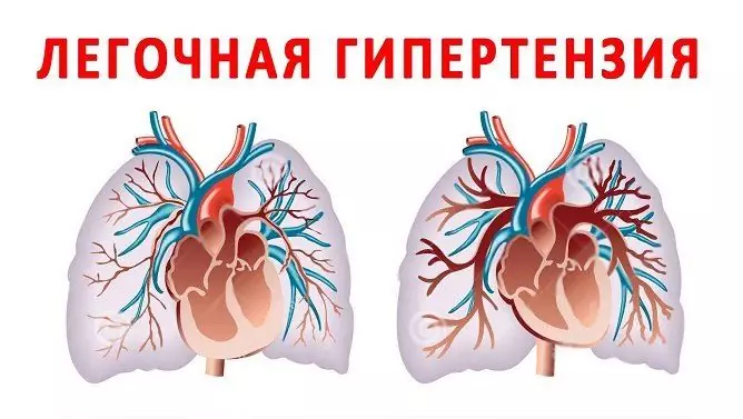 Hipertensi Pulmonal: Gejala, Apa Itu, Pengobatan, Prognosis, Tanda