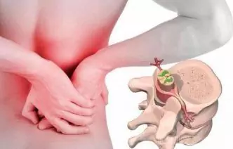 ¿Cómo Vivir Con Una Hernia De Columna?