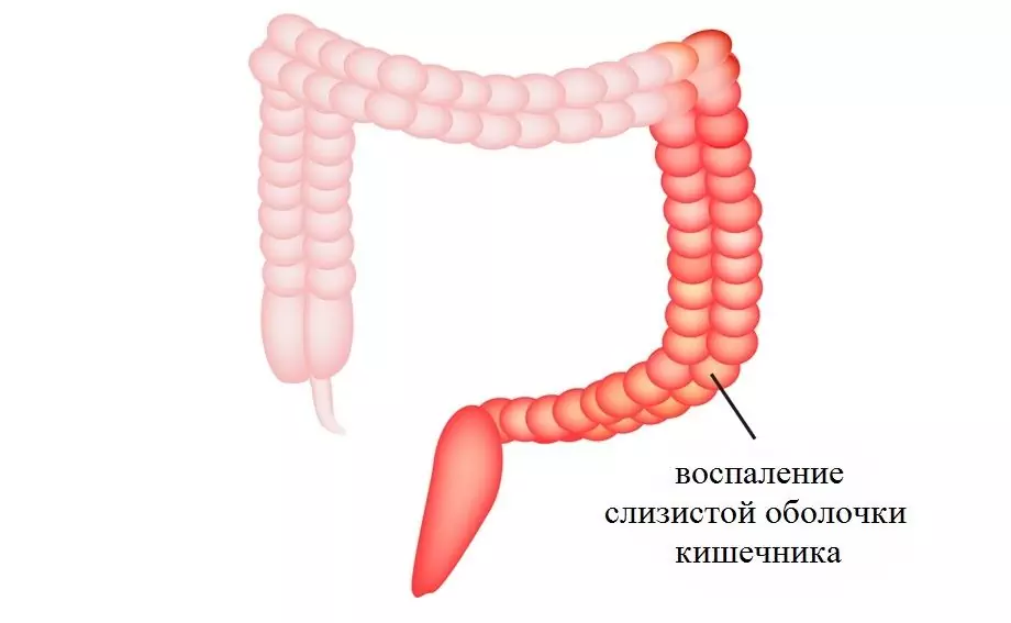 Колит - симптоми, лечение, диета, причини, колит по време на бременност