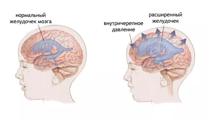 Megnövekedett Koponyaűri Nyomás - Tünetek, Kezelés Gyermekeknél és Felnőtteknél