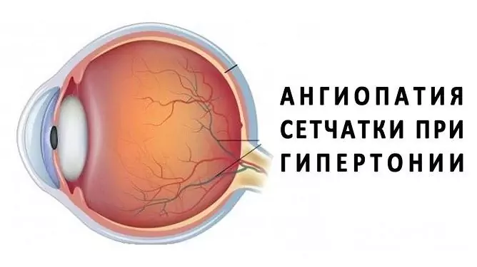 Retinal angiopati er almindelig, især i avancerede stadier af hypertension