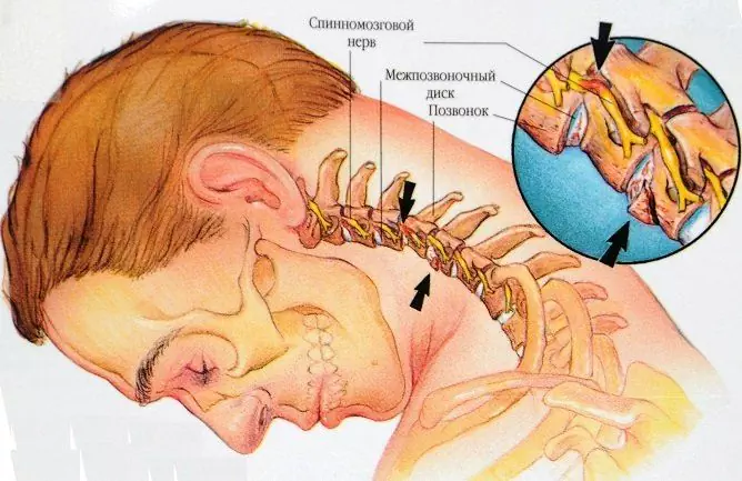 Cervikal Osteokondrose - Symptomer, Behandling, øvelser, Massasje, Tegn