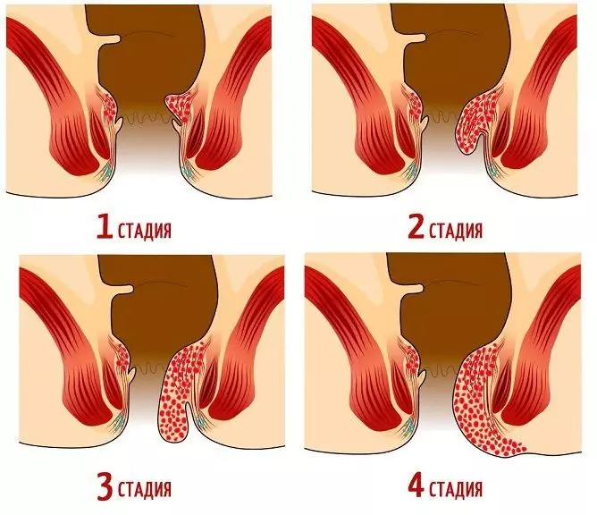 Sang Dans Les Selles Chez Un Adulte: Causes Du Sang écarlate Et Noir, Mucus