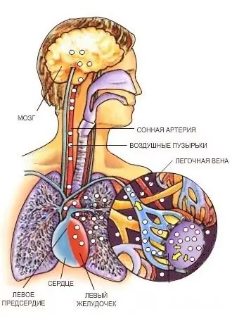 Barotrauma plic