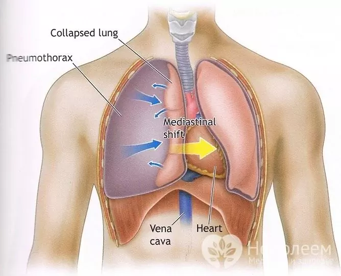 Napínací pneumotorax s barotraumou