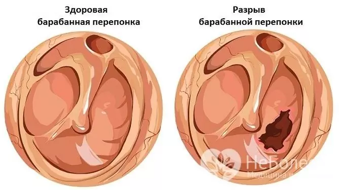 Ušní barotrauma může být doprovázeno prasknutím tympanické membrány