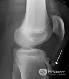 Diagnosticul bolii Osgood Schlatter