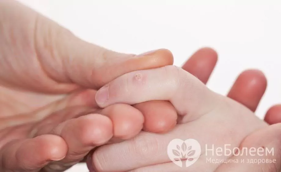 Warts in children: causes and symptoms