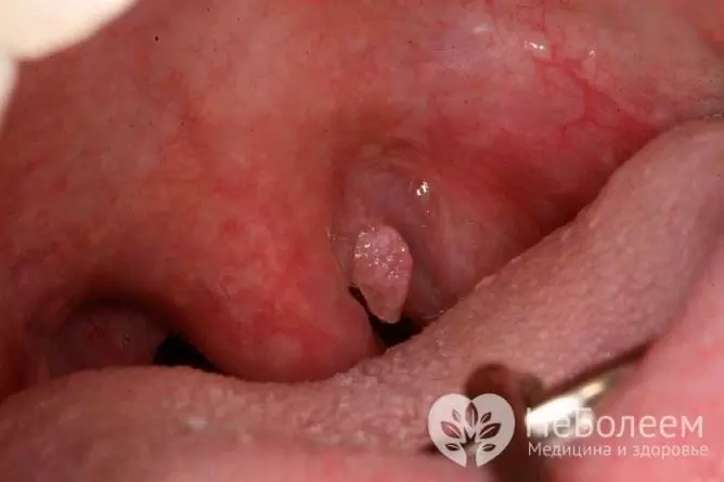 A rather rare form of wart lesion - laryngeal papillomatosis