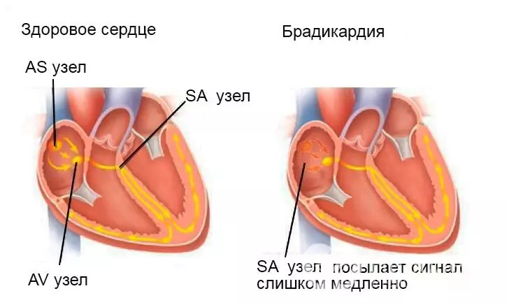 Signs of bradycardia