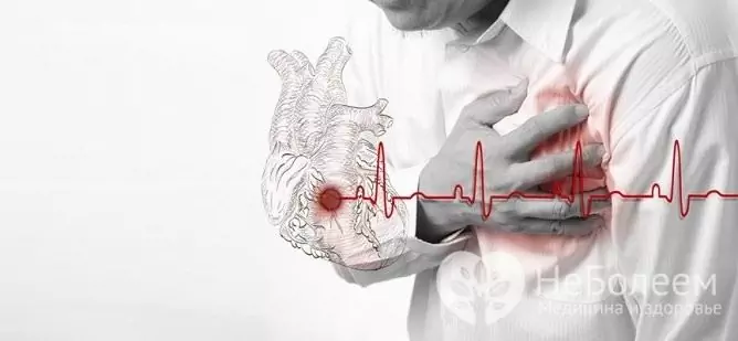 La bradicardia a menudo se desarrolla en el contexto de un infarto de miocardio previo