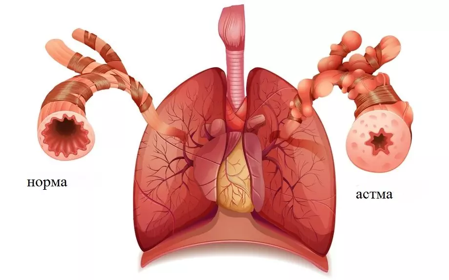 Bronchiálna Astma U Detí - Príznaky, Liečba, Prevencia, Príznaky