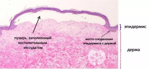 Microstruttura di un campione di pelle di un paziente con epidermolisi bollosa