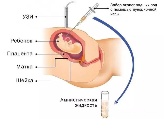 Lootevedelikku uurides saab epidermolysis bullosa diagnoosida enne lapse sündi