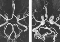 Complete and incomplete circle of Willis