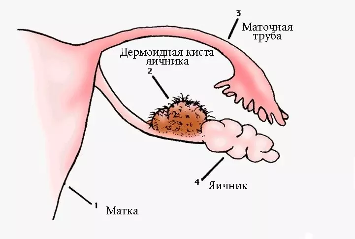 Dermoid Petefészek Ciszta A Jobb, A Bal Oldalon - Tünetek, Kezelés, Okok