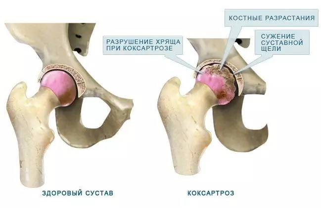 Merubah Arthrosis Lutut, Sendi Pinggul - Rawatan