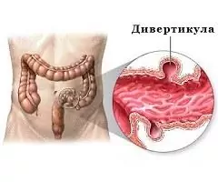 Diverticulosis: formación de divertículos en las paredes intestinales