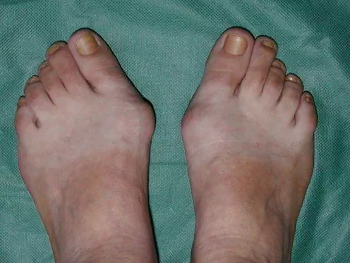 Hallux Valgus Of The Foot And Toes - Treatment