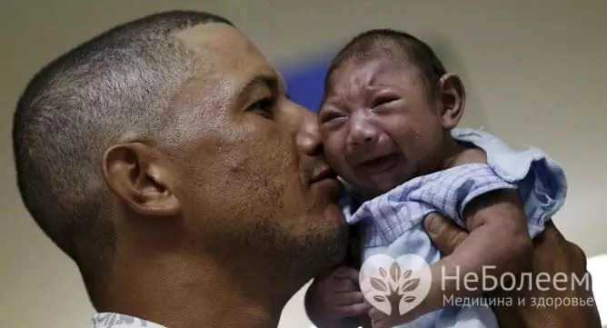 Penularan virus Zika dari ibu ke janin berisiko tinggi melahirkan bayi dengan mikrosefali