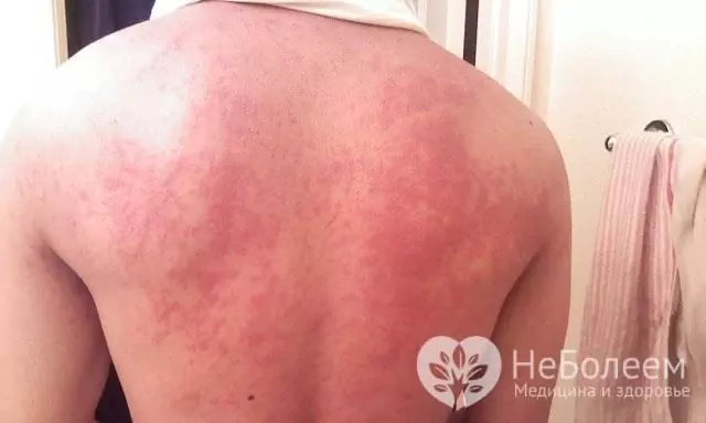 This is what a Zika rash looks like