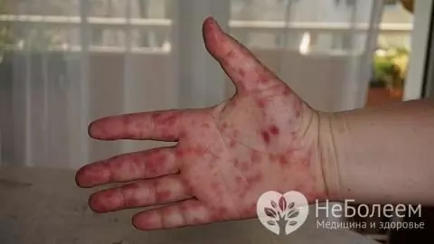 Coxsackie virus type A mainly affects the skin of children