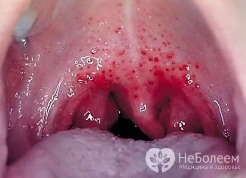 In children 3-10 years old, the Coxsackie virus often provokes the development of herpetic sore throat