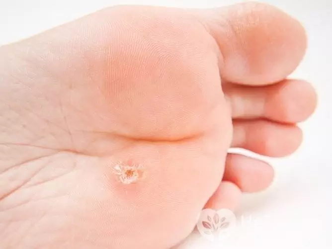 Plantar warts are caused by HPV